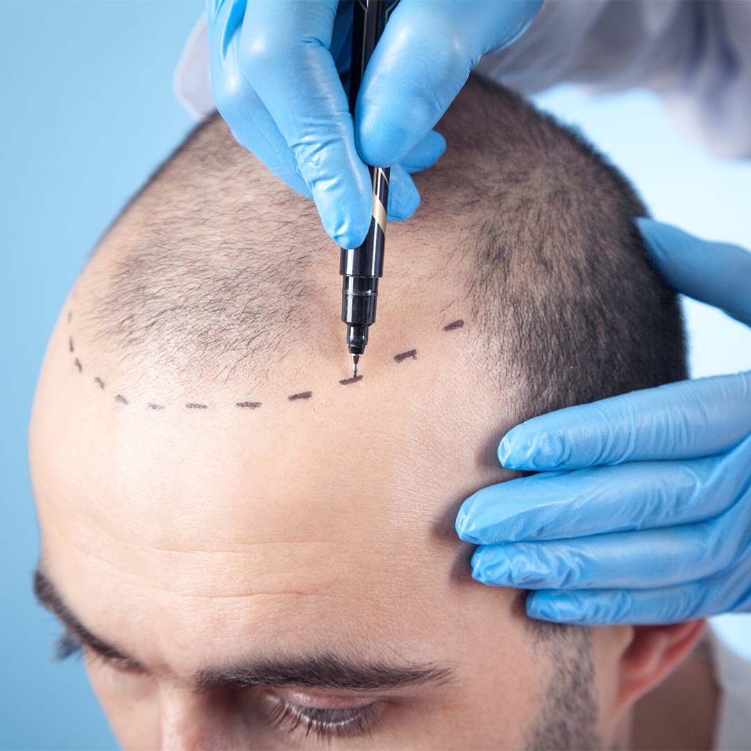 blog-vt2p1Z https://www.asemhairtransplant.com/wp-content/uploads/2025/04/blog-vt2p1Z.jpg