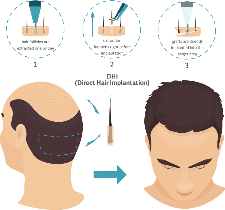 dhi-hair-transplant-procedure https://www.asemhairtransplant.com/wp-content/uploads/2025/04/dhi-hair-transplant-procedure.png