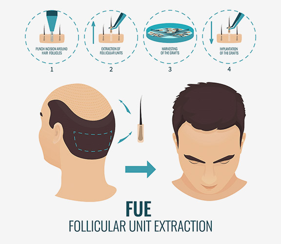 fue-technique-hair-transplant-1 https://www.asemhairtransplant.com/wp-content/uploads/2025/04/fue-technique-hair-transplant-1.jpg